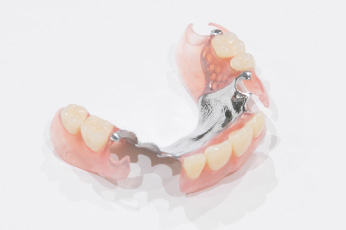 メタルプレート精密義歯